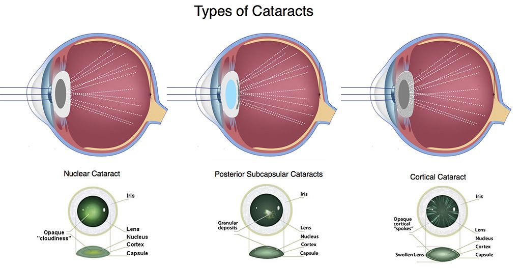 Image Showing Types of Cataracts